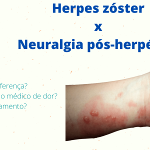 herpes-zoster-neuralgia
